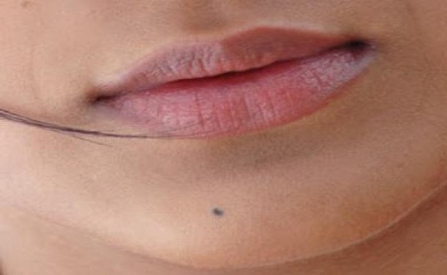 جفاف منطقة ما حول الفم