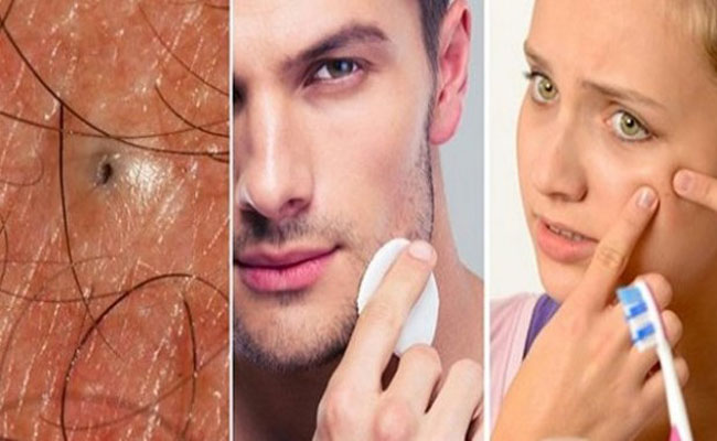وصفة قوية للتخلص من الرؤوس السوداء بسرعة.. جربيها ستعجبك