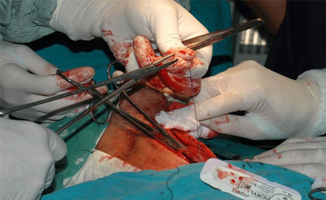 بعد 10 سنوات من المعاناة استئصال ورم مبيضي ضخم يزن 37 كلغ من جسم سيدة بمستفشى تيسمسيلت