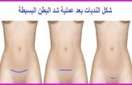 تفكرين في جراحة شد البطن بعد الولادة؟ لا تتجاهلي هذه التعليمات