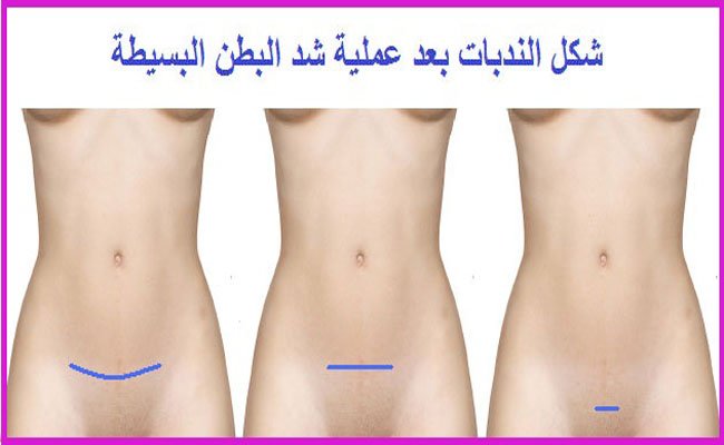 تفكرين في جراحة شد البطن بعد الولادة؟ لا تتجاهلي هذه التعليمات