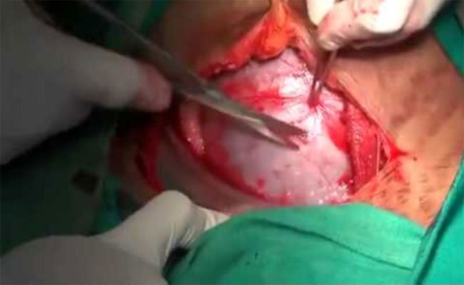 طاقم طبي يتم جره للمحاكمة بعد أن نسي ضمادة في رحم سيدة أجرت عملية قيصرية للولادة!