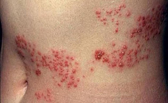 كيف يمكن علاج الحزام الناري ومواجهة الإلتهاب الفيروسي؟