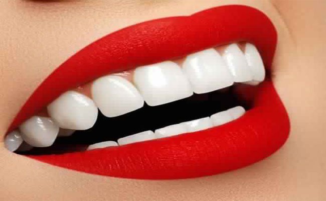 فكّري مرتين قبل تلبيس الأسنان لأغراض جمالية!