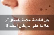 الشامة ليست خطيرة إلا في حال حصول هذه التغيّرات!