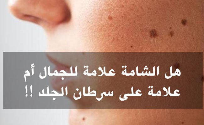 الشامة ليست خطيرة إلا في حال حصول هذه التغيّرات!
