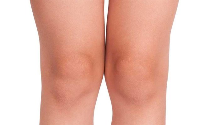 4 أسباب تسبب إسمرار الركبتين... اكتشفيها!