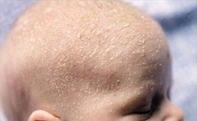 إقتراحات طبّية لمعالجة قشرة الشعر عند الرضّع