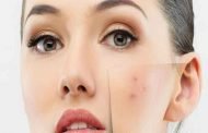 أفضل 3 علاجات للتخلص من البثور الحمراء في الوجه!