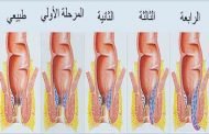 كيف يتم علاج الناسور بدون جراحة؟