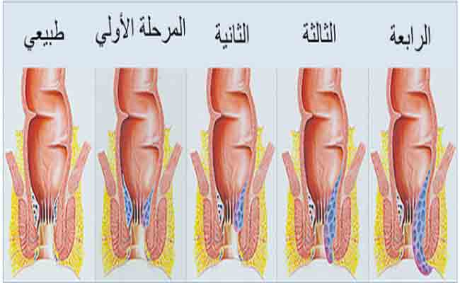 كيف يتم علاج الناسور بدون جراحة؟