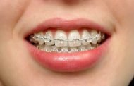 هل تعرفين أنّ هناك 4 أنواع من تقويم الاسنان؟