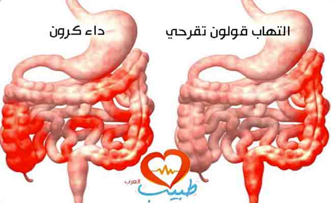 كيف يمكن علاج التهاب الامعاء؟