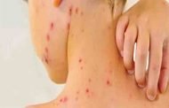 تسجيل 254 حالة إصابة بداء الحصبة 