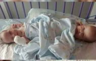 عملية جراحية ناجحة لفصل توأم ملتصق من ميلة بمستشفى بباريس