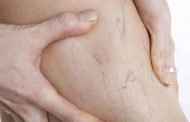 دوالي الساقين خلال الحمل... كيف تتفادينها؟