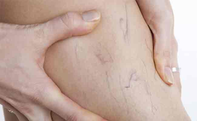 دوالي الساقين خلال الحمل... كيف تتفادينها؟