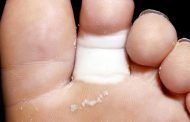 فطريات القدم خطيرة على أبواب الصيف