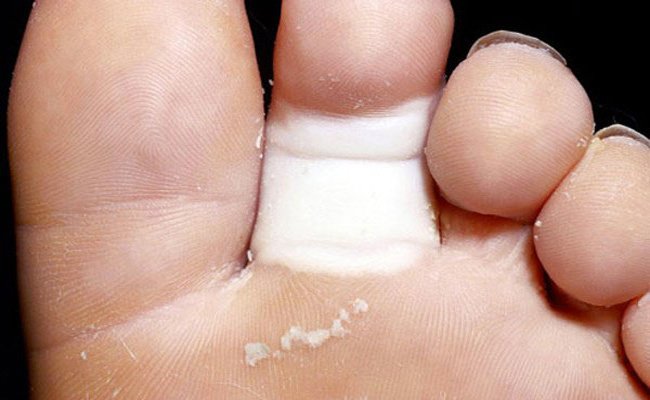 فطريات القدم خطيرة على أبواب الصيف