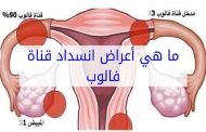 كيف يمكن علاج انسداد قناة فالوب؟