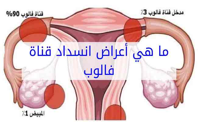 كيف يمكن علاج انسداد قناة فالوب؟