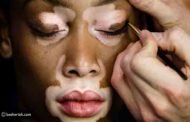 هل صحيح ان علاج البهاق بالليزر فعّال؟