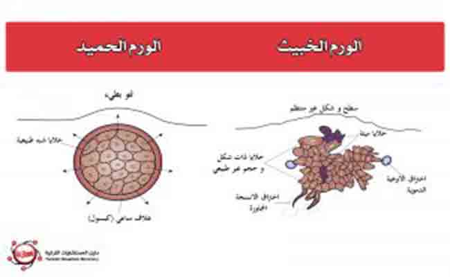 هل تعرفون الفروقات المهمّة التي تميّز الورم الحميد عن الخبيث؟