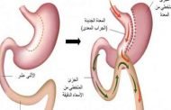 كيف تتم عملية غسل المعدة؟