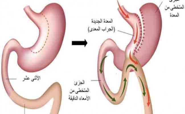 كيف تتم عملية غسل المعدة؟