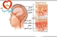 ما هو التهاب السحايا المعدي؟
