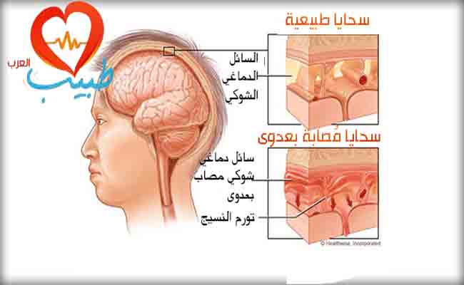 ما هو التهاب السحايا المعدي؟