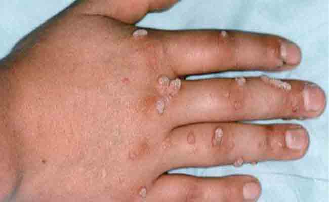 اكتشفوا معنا انواع الثآليل الجلدية وطرق الوقاية منها