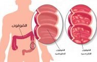 ما هي اسباب حدوث التهاب في المستقيم؟
