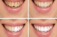كيف تتخلصون من صفار الأسنان بطرق طبيعية؟