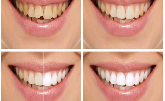 كيف تتخلصون من صفار الأسنان بطرق طبيعية؟