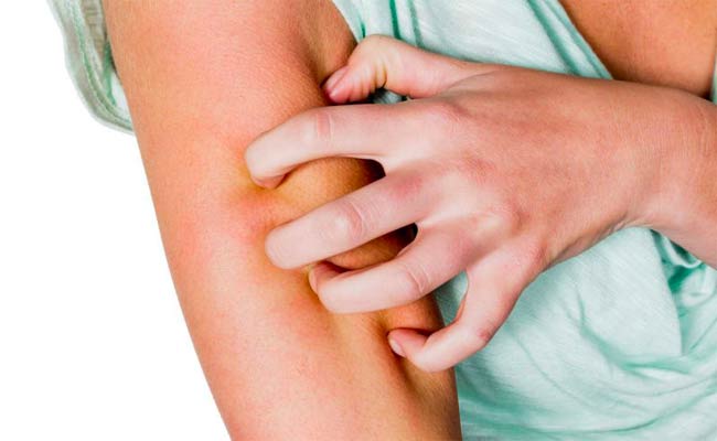 4 نصائح أساسية تساعدكم على تفادي فورة الصدفية في فصل الشتاء!
