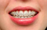 هل تعرفين أنّ هناك 4 أنواع من تقويم الاسنان؟