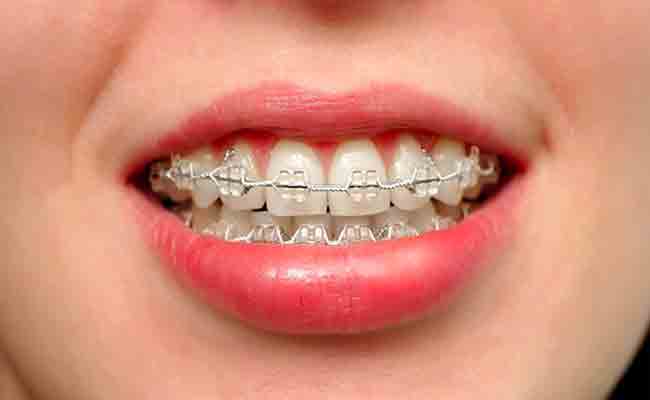 هل تعرفين أنّ هناك 4 أنواع من تقويم الاسنان؟