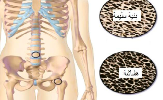 هل يُسبّب مرض هشاشة العظام الألم؟