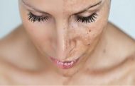 تعرفي على أهم طرق علاج كلف الحمل!