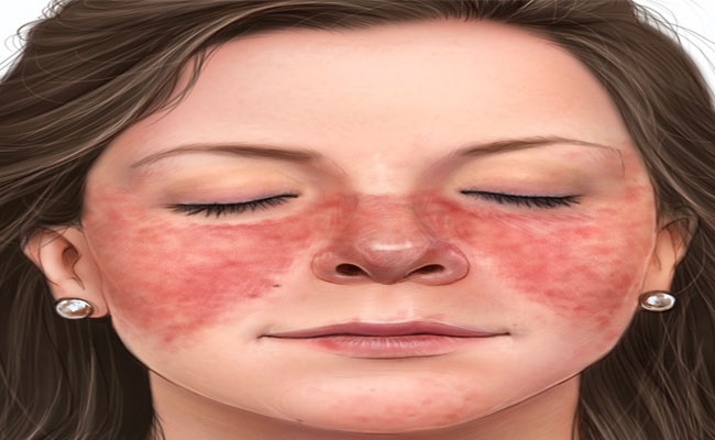 هل يشكل مرض الذئبة الحمراء خطراً على الحمل؟