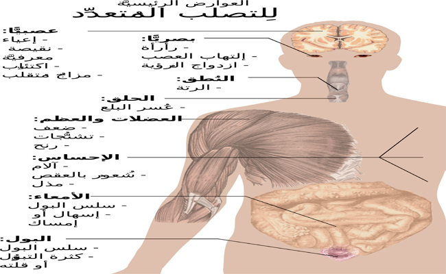 ما هو مرض التصلّب اللويحي وما مدى خطورته؟