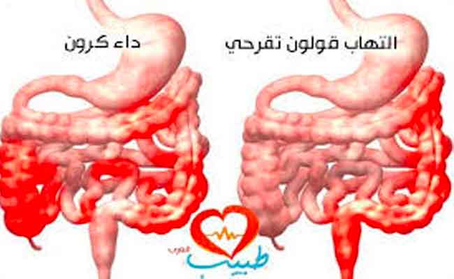 هل يمكن الحمل دون مشاكل مع مرض الكرون؟