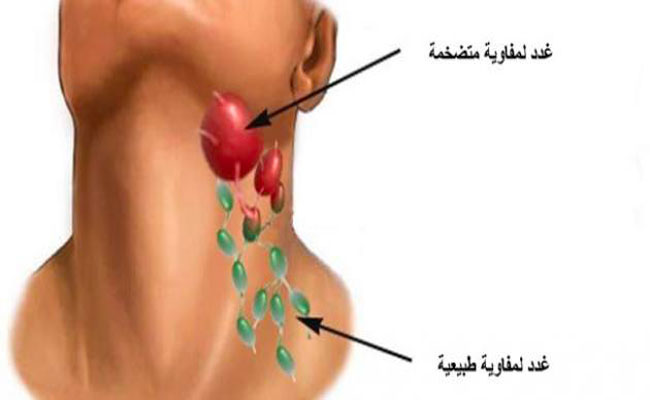 ما هي أعراض التهاب الغدد اللمفاوية في الرقبة؟