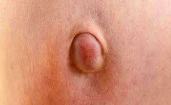 أنواع الفتق عند الرّضع؟ ومتى يجب التدخّل جراحياً...؟