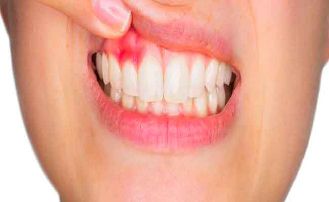 كيف تحمين نفسك من التهاب اللثة خلال الحمل...؟