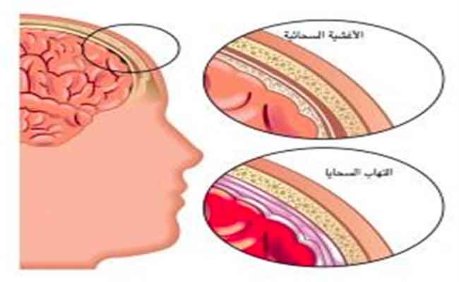 لماذا يتعرّض الأطفال الرضّع إلى التهاب السحايا...؟