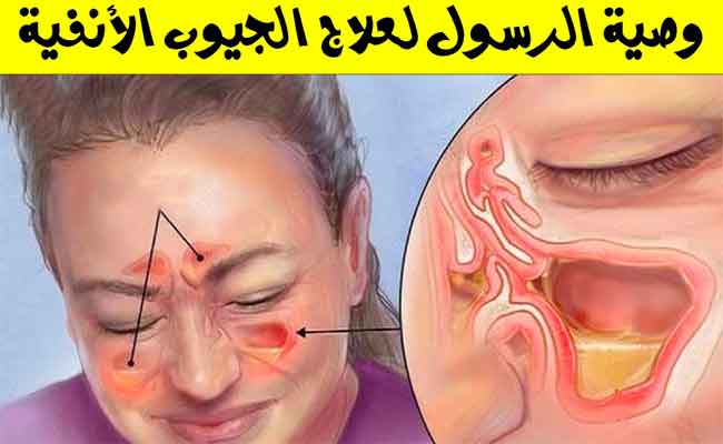 ماذا تعرفون عن التهاب الجيوب الأنفية...؟