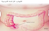 هل يمكن علاج الزائدة الدودية خلال الحمل...؟
