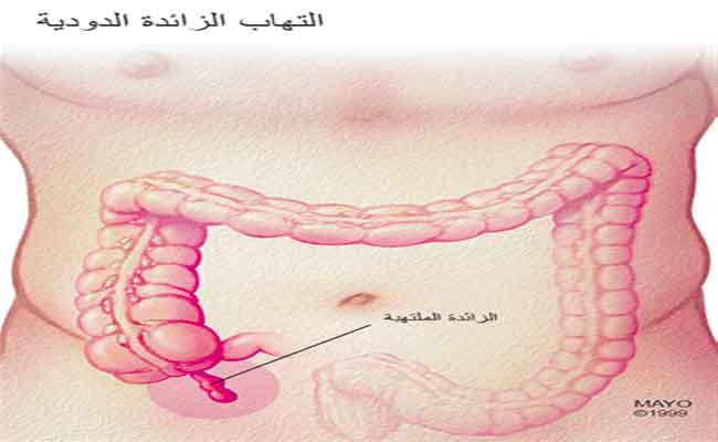 هل يمكن علاج الزائدة الدودية خلال الحمل...؟